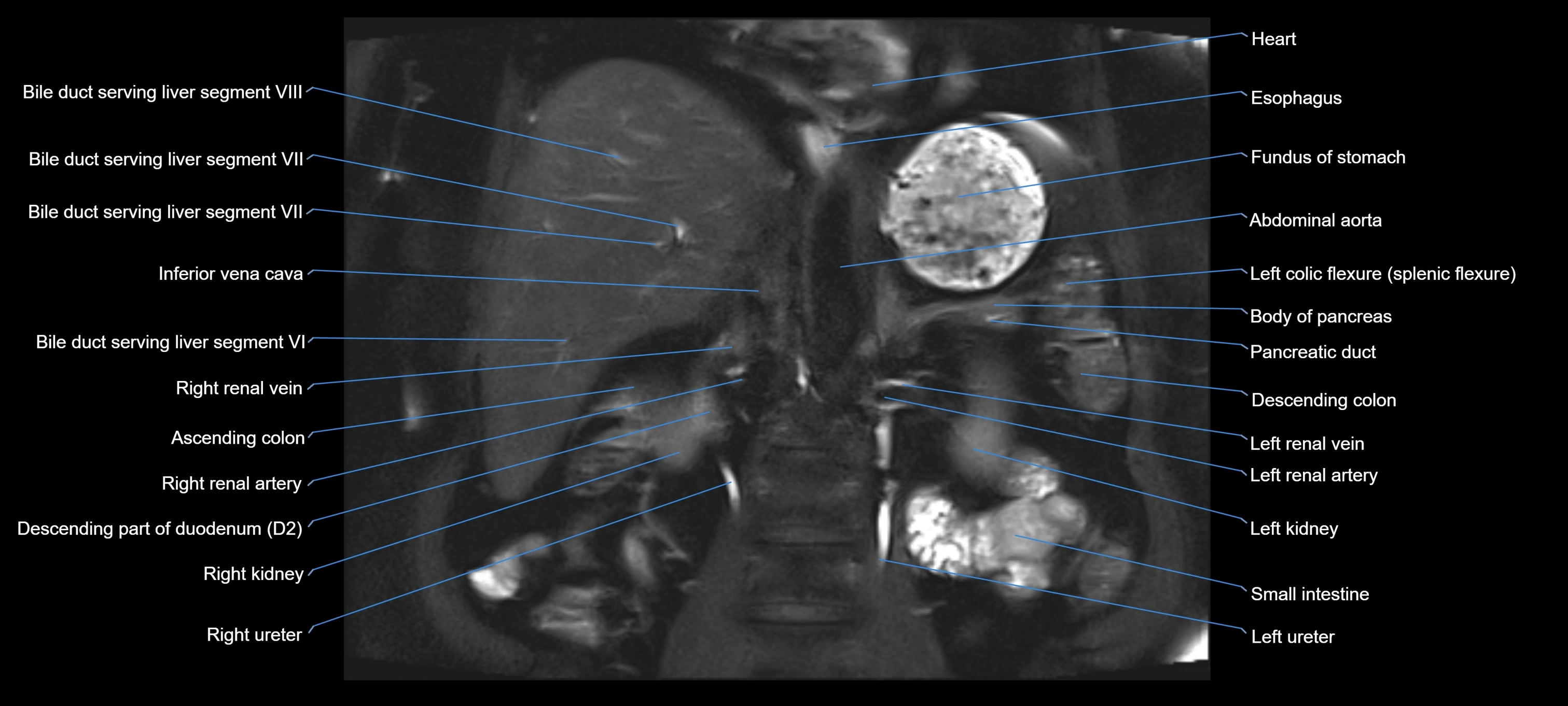 MRI MRCP coronal cross sectional 3T radiology  image-img-00001-00016.webp